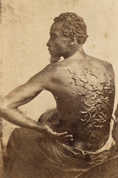 Black and white photograph of Gordon, also known as Whipped Peter, who was an enslaved African-American who escaped from a Louisiana plantation in March 1863. His back shows grotesque scars from many, many whippings.